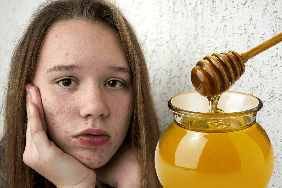 Honig Gegen Pickel Ein Biologe Klart Auf